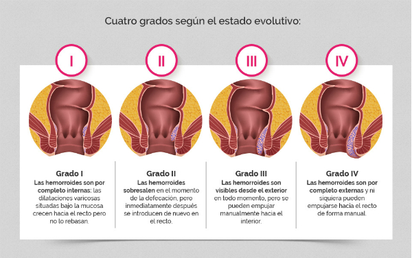 hemorroides externas