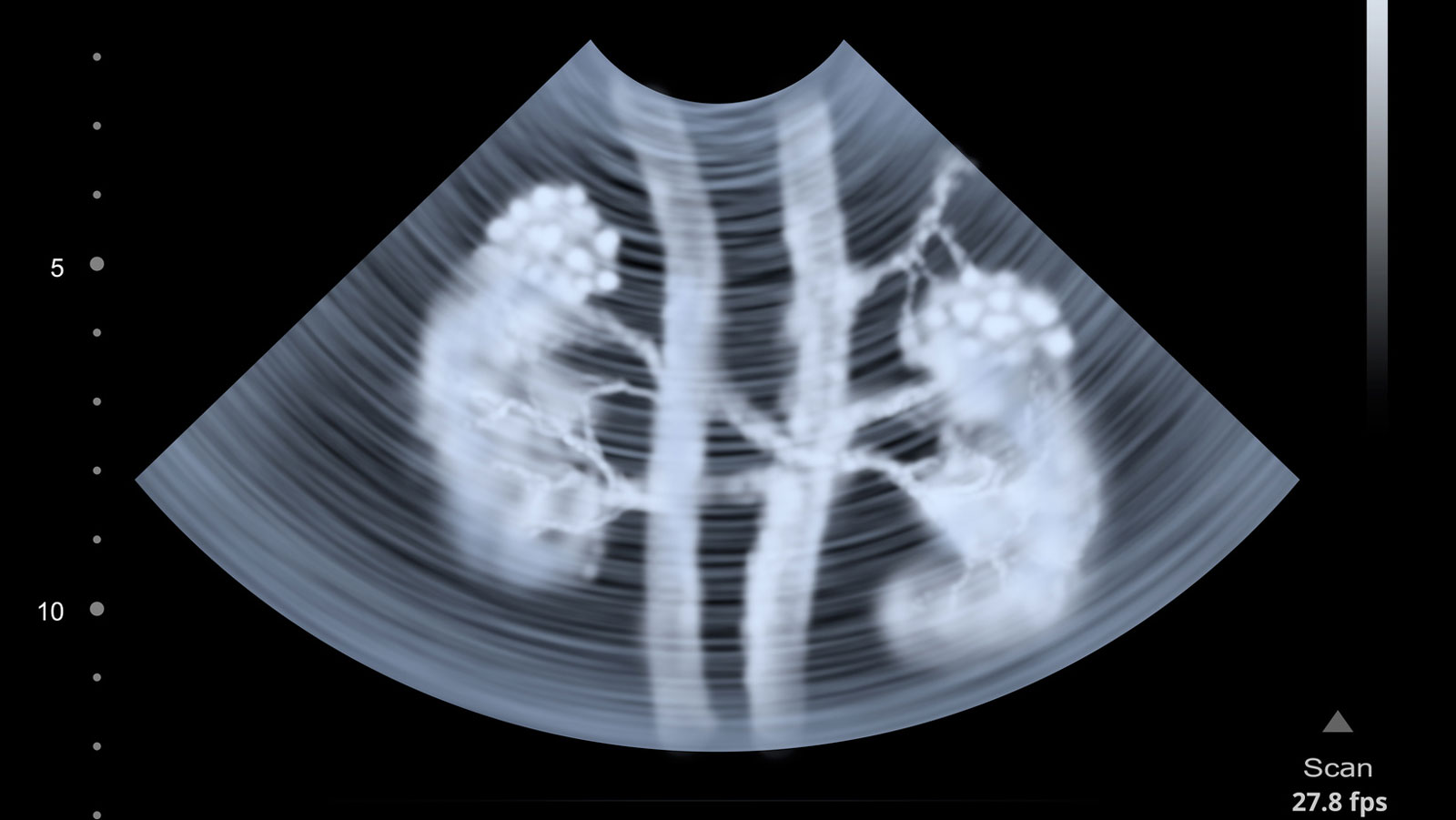 dieta cetogenica problemas