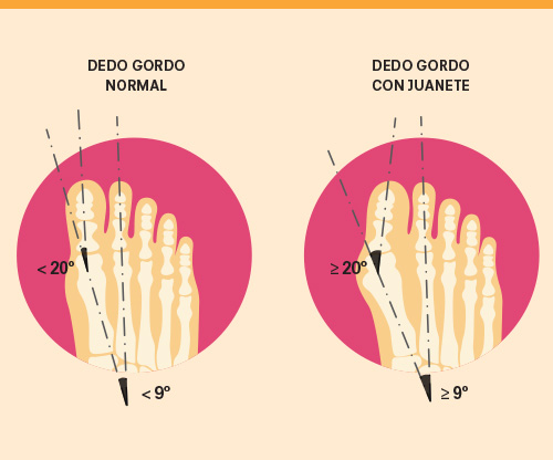 juanetes en los pies 
