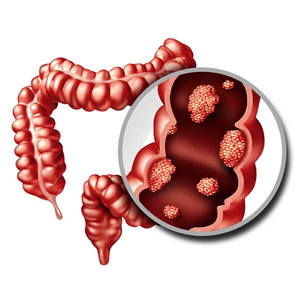 Cáncer de colon: así son los pólipos