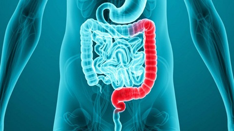 colitis-ulcerosa