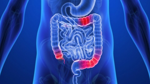 enfermedad-crohn