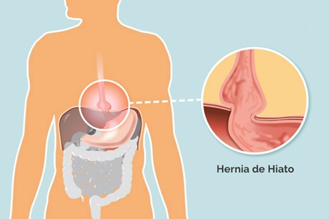 hernia-de-hiato