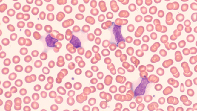 mononucleosis