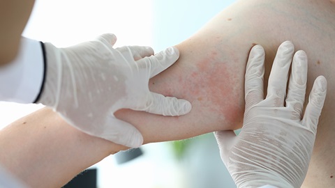 psoriasis